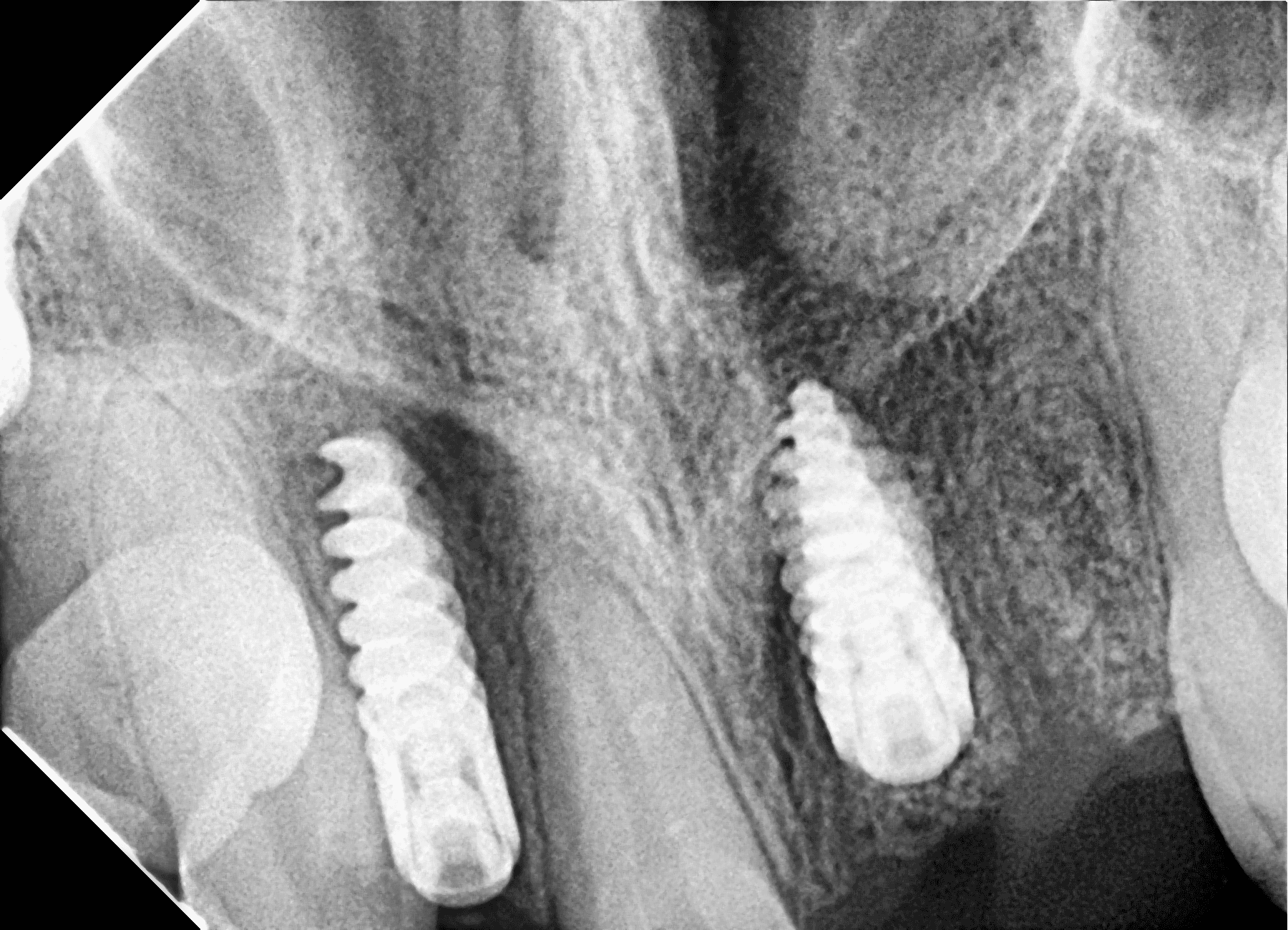 Premium Implants Transformation