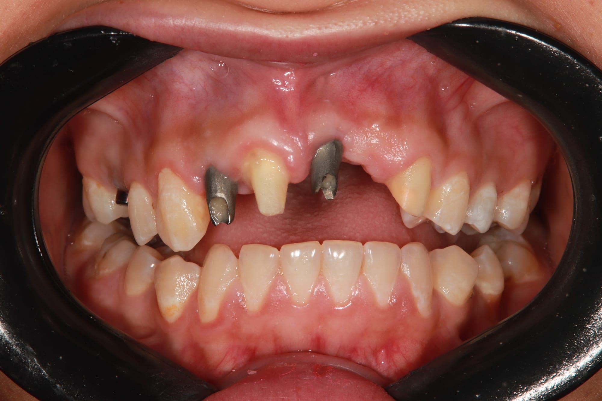 Premium Implants Transformation — before treatment