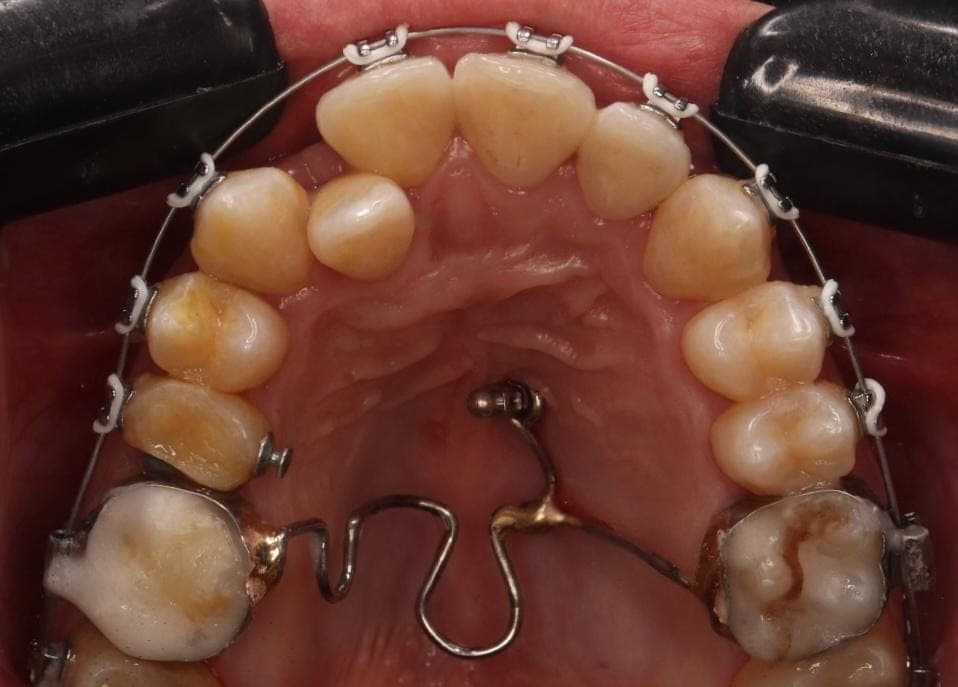 Premium Orthodontics Transformation — after