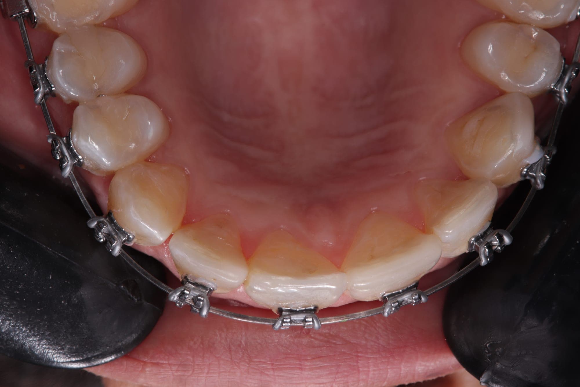 Premium Orthodontics Transformation — after