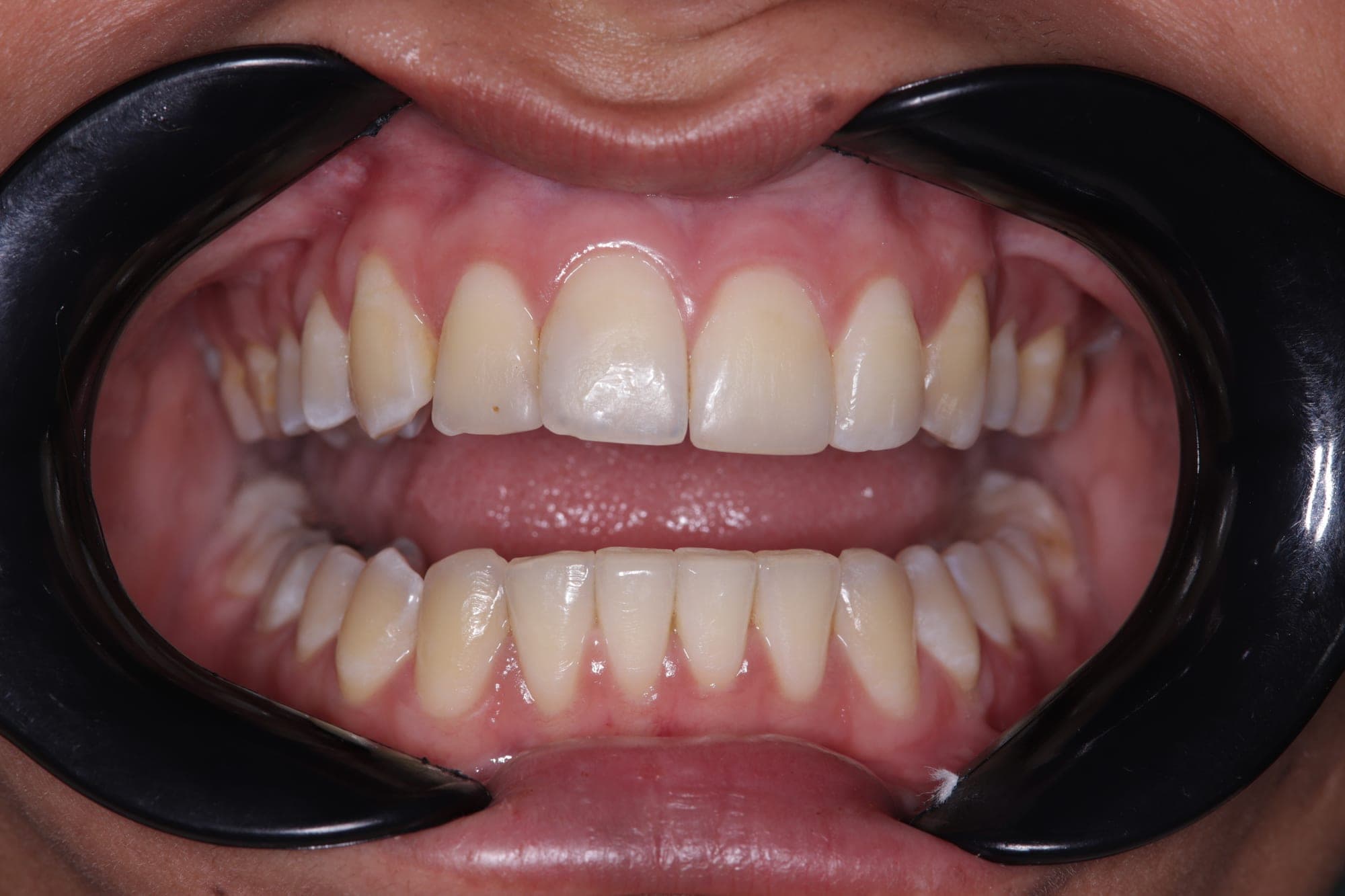 Premium Orthodontics Transformation — before