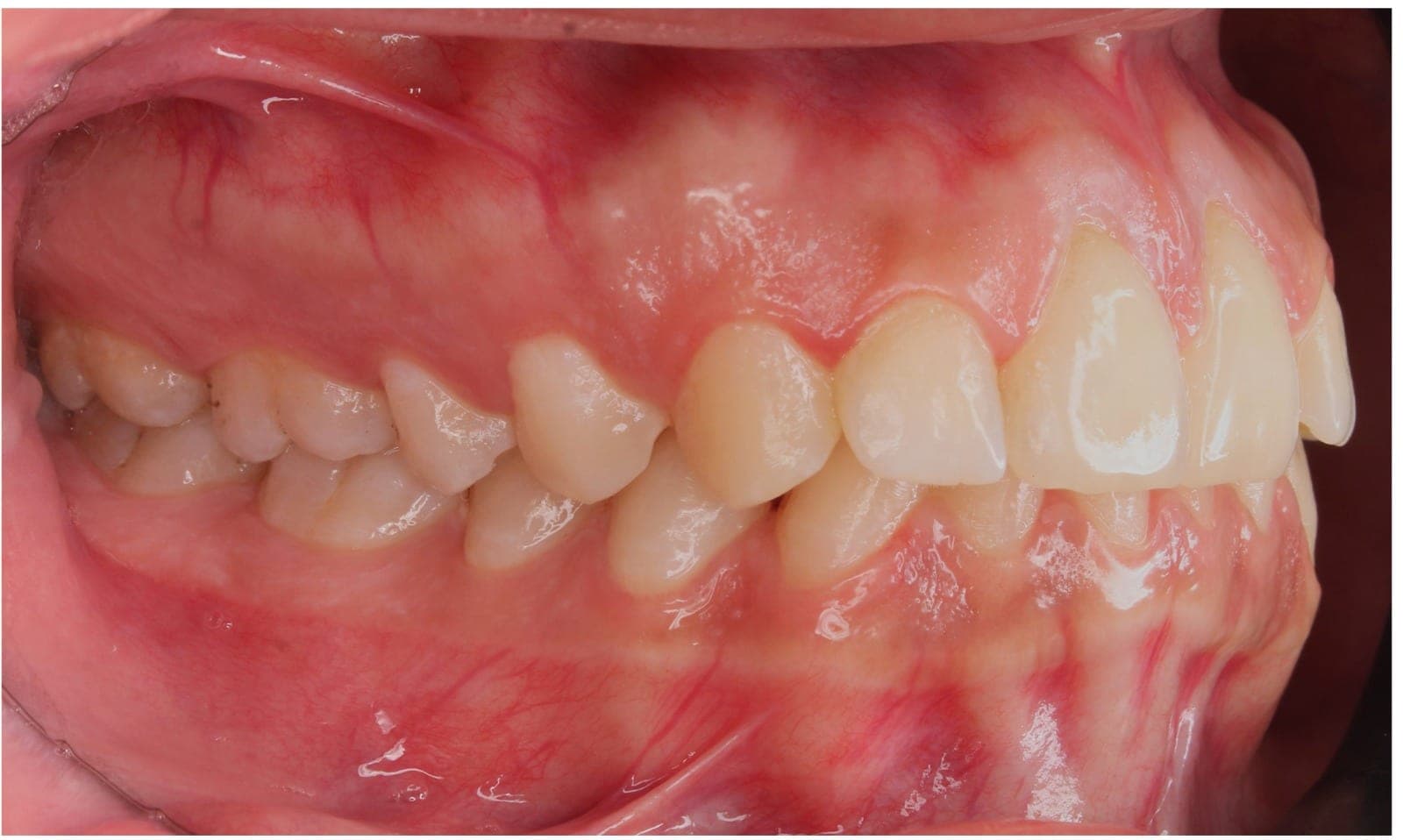 Premium Orthodontics Transformation — after treatment