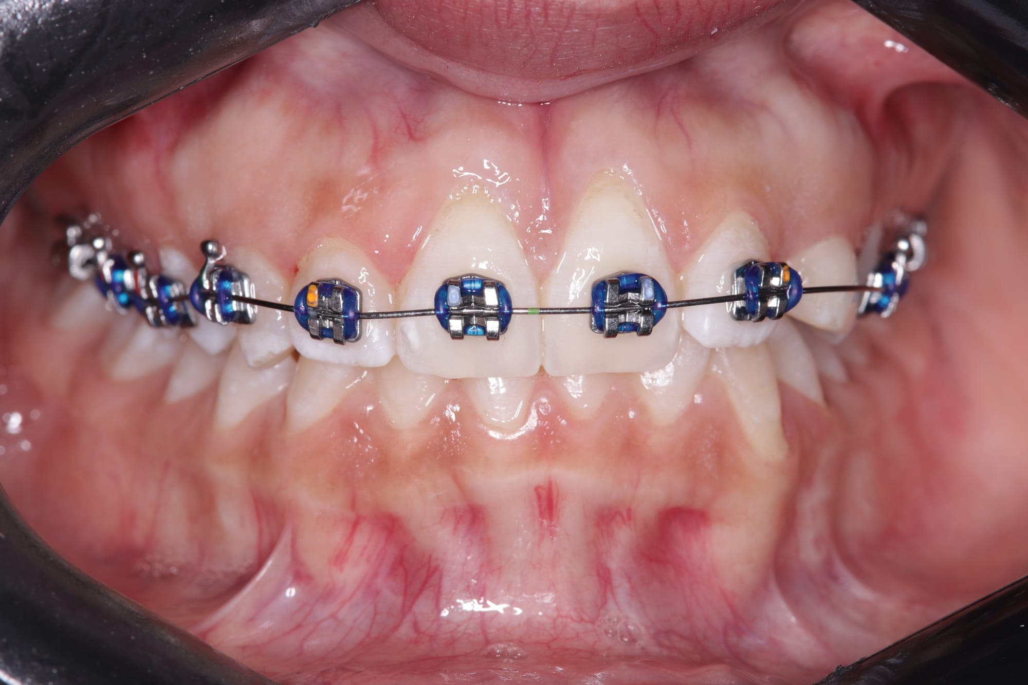 Premium Orthodontics Transformation — before treatment