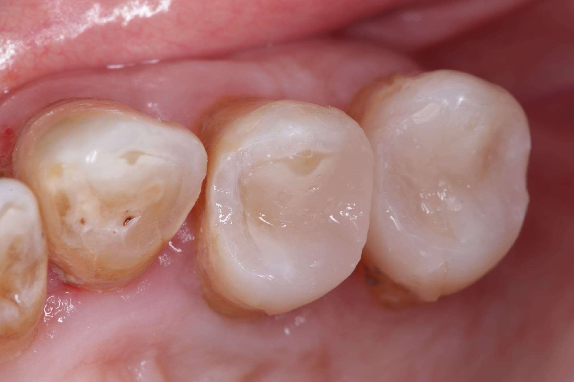 Premium Cosmetic Transformation — after treatment