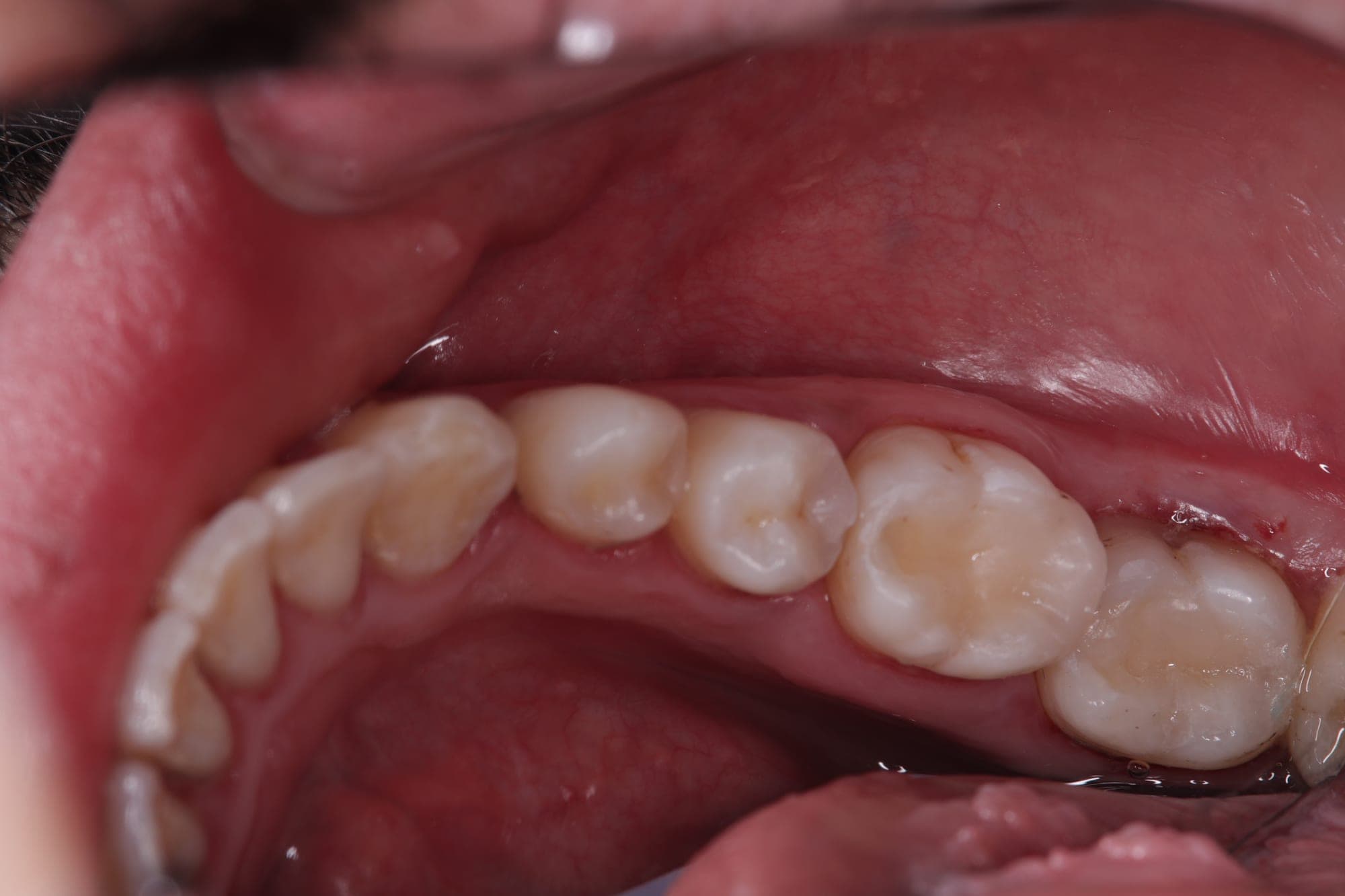 Premium Cosmetic Transformation — after treatment