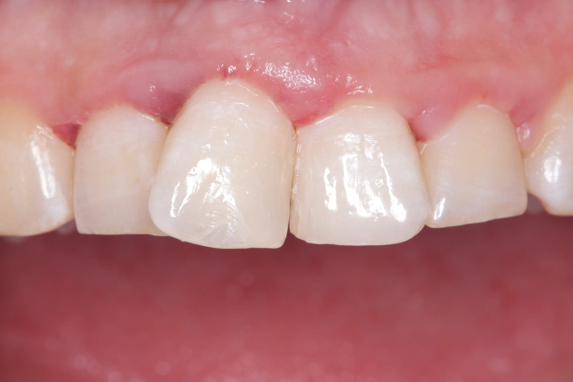 Premium Cosmetic Transformation — after treatment