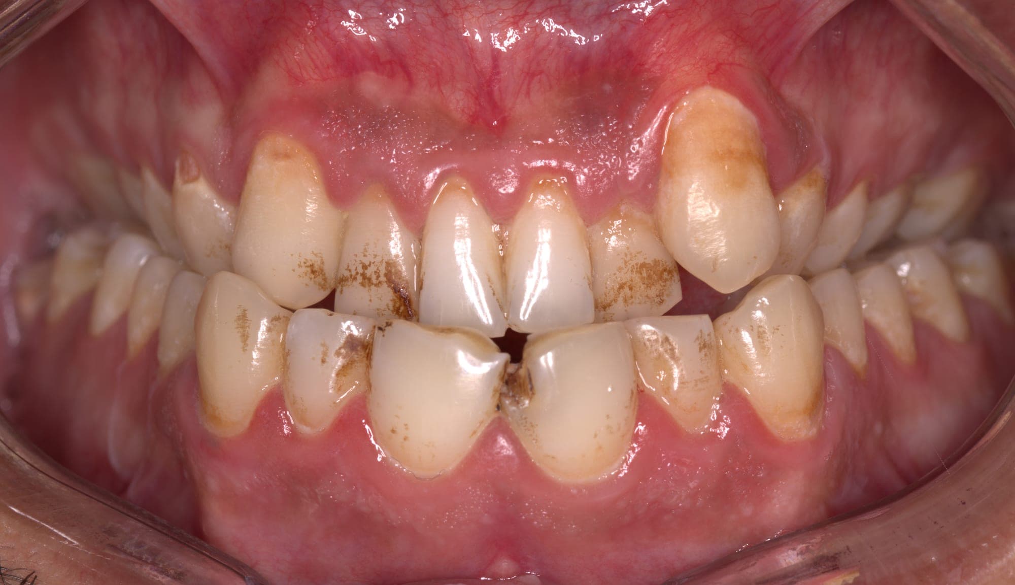 Premium Cosmetic Transformation — after treatment