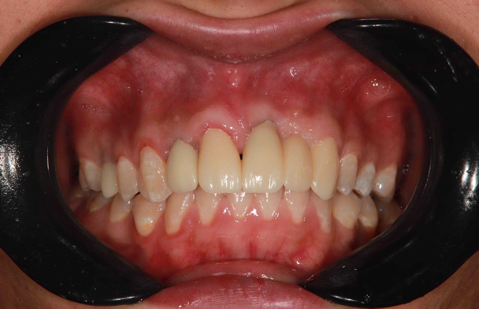 Premium Cosmetic Transformation — after treatment