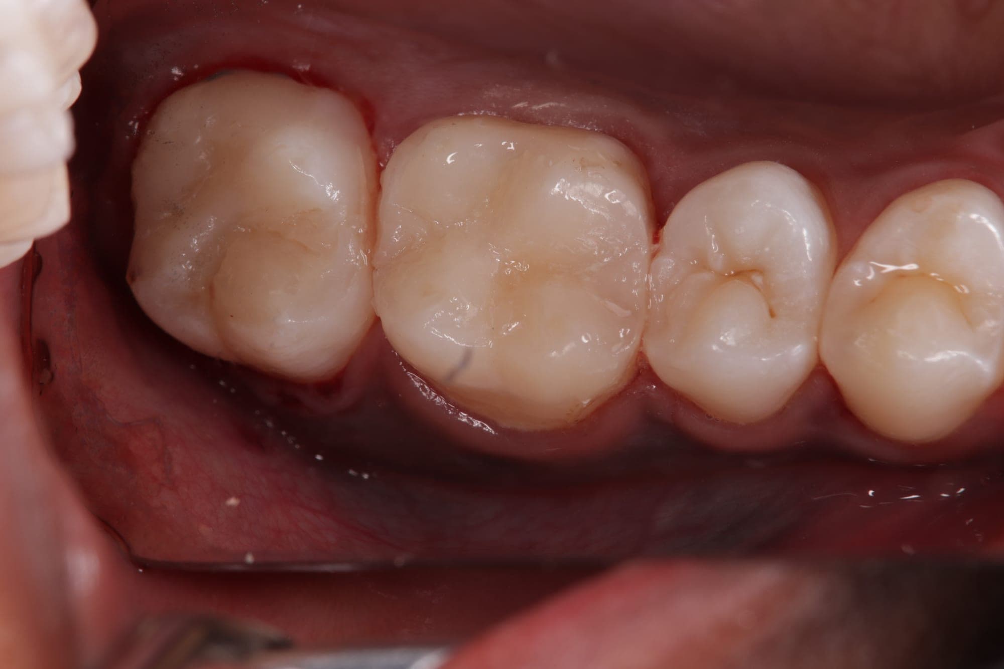 Premium Cosmetic Transformation — after treatment