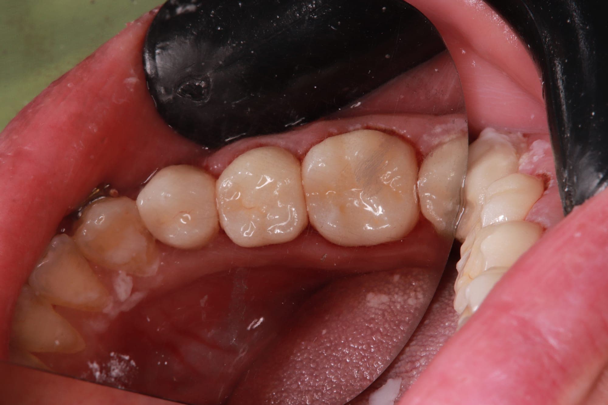 Premium Cosmetic Transformation — after treatment