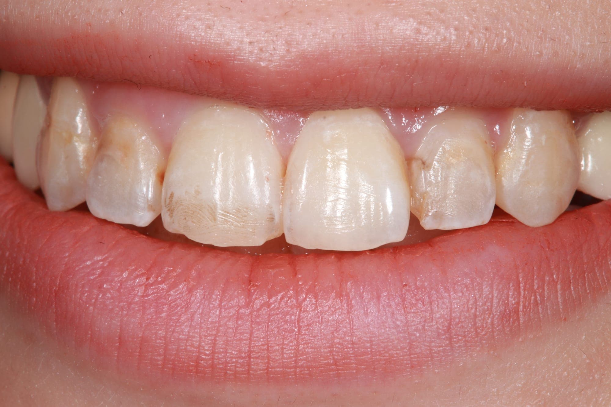 Premium Cosmetic Transformation — after treatment