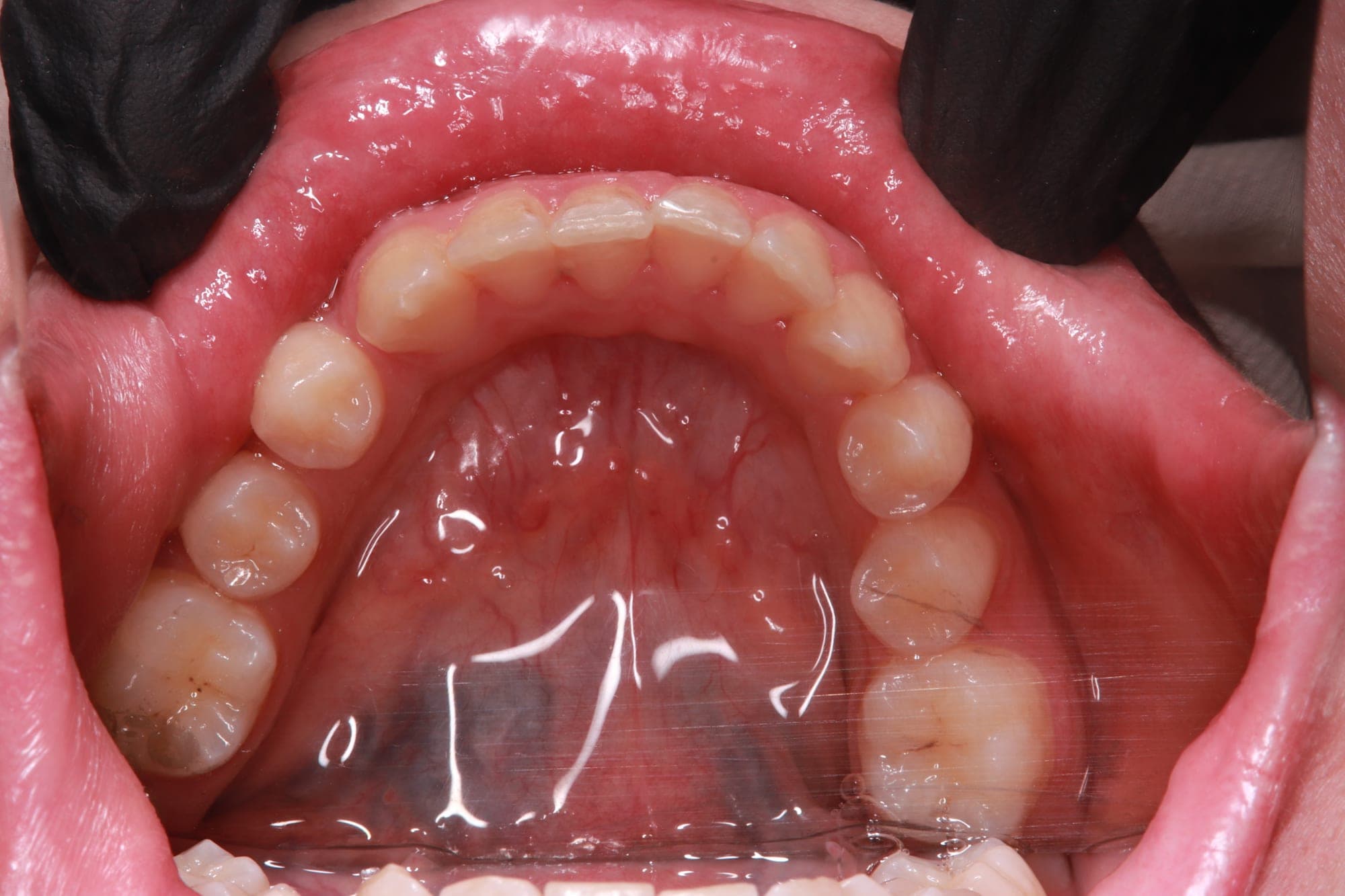 Premium Orthodontics Transformation — after treatment