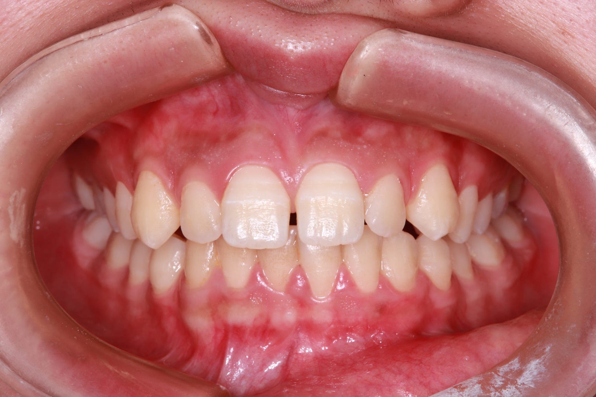 Premium Orthodontics Transformation — before treatment