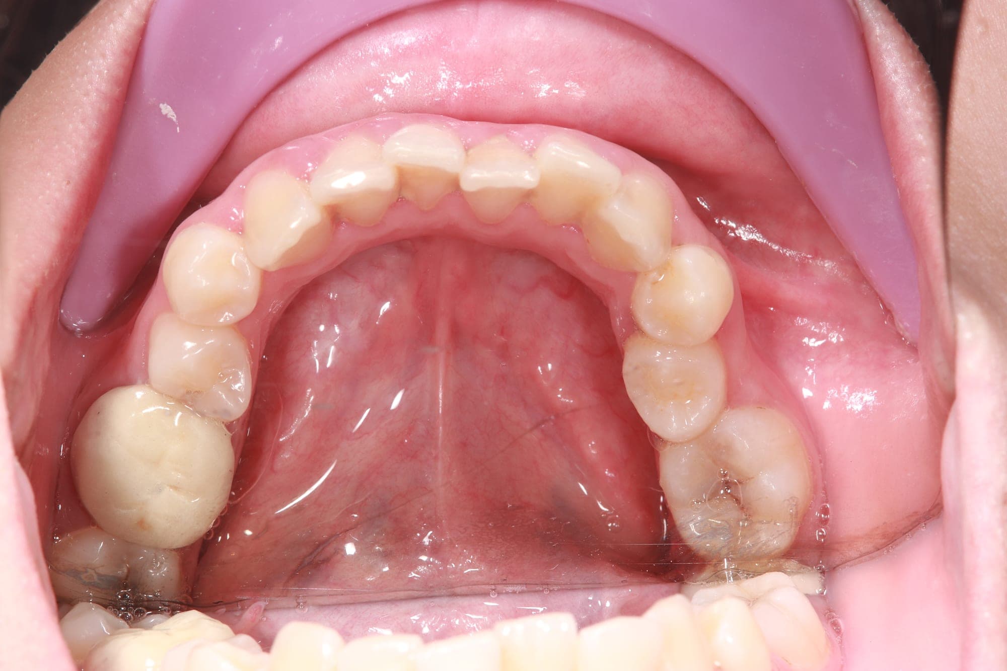Premium Orthodontics Transformation — after treatment