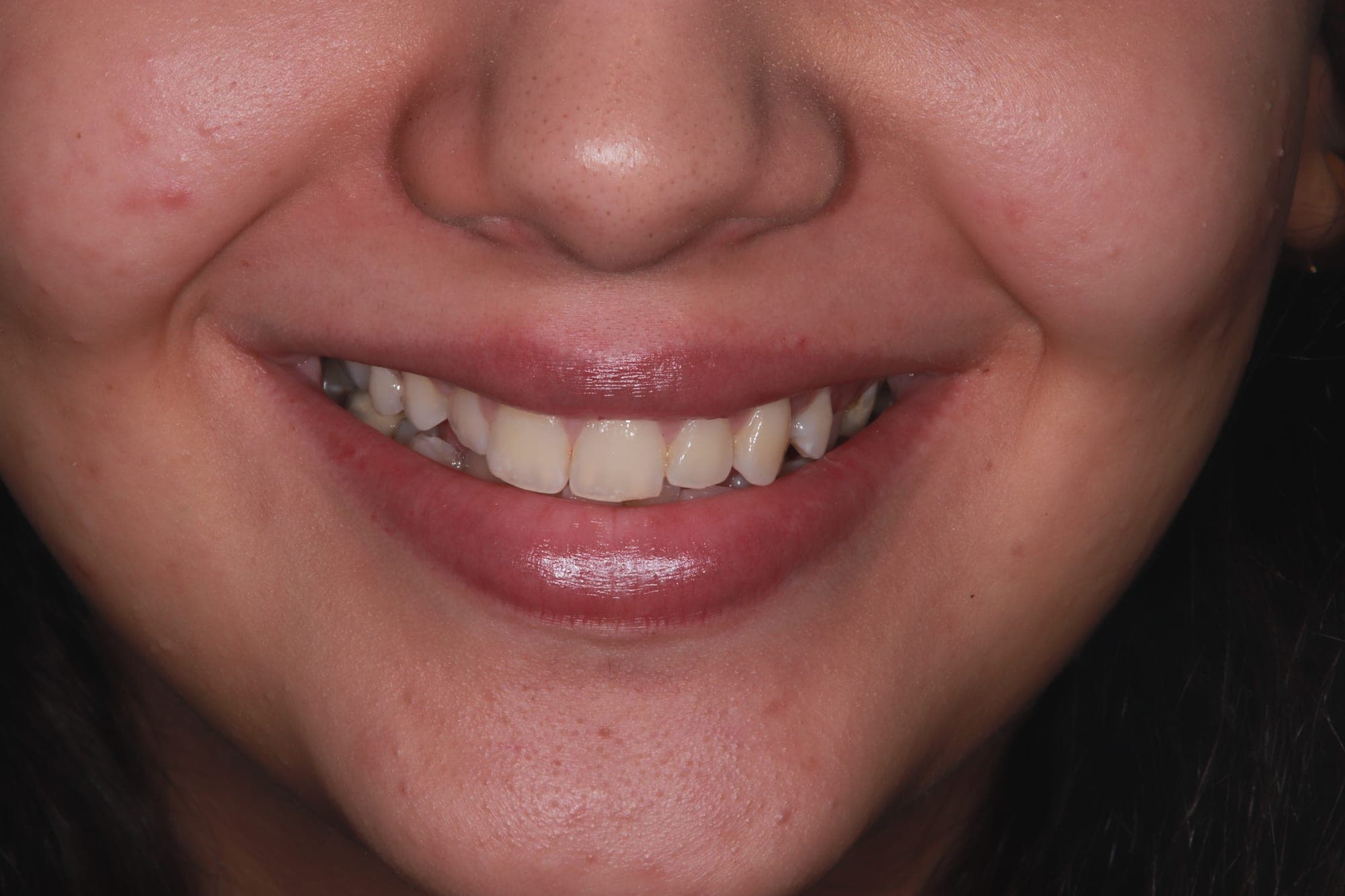 Premium Orthodontics Transformation — before treatment