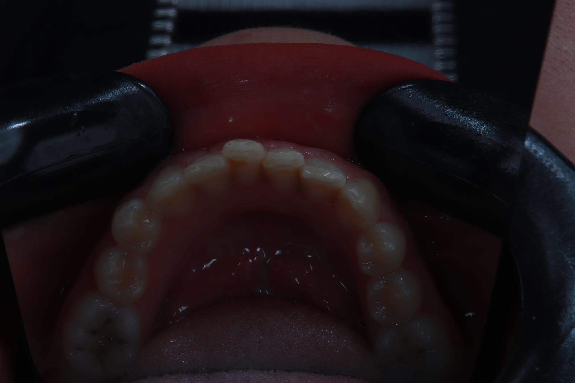 Premium Orthodontics Transformation — after treatment