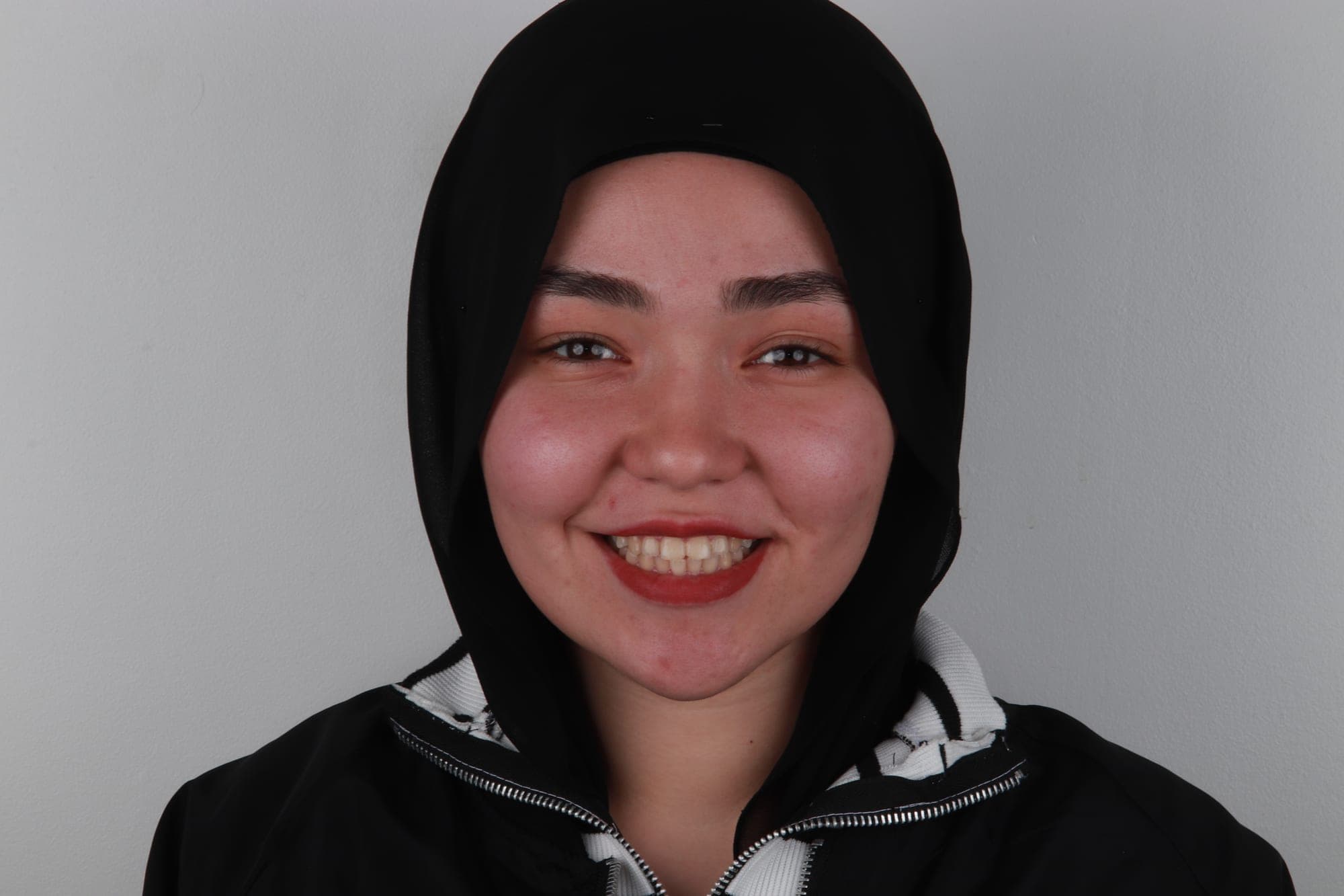 Premium Orthodontics Transformation — before treatment