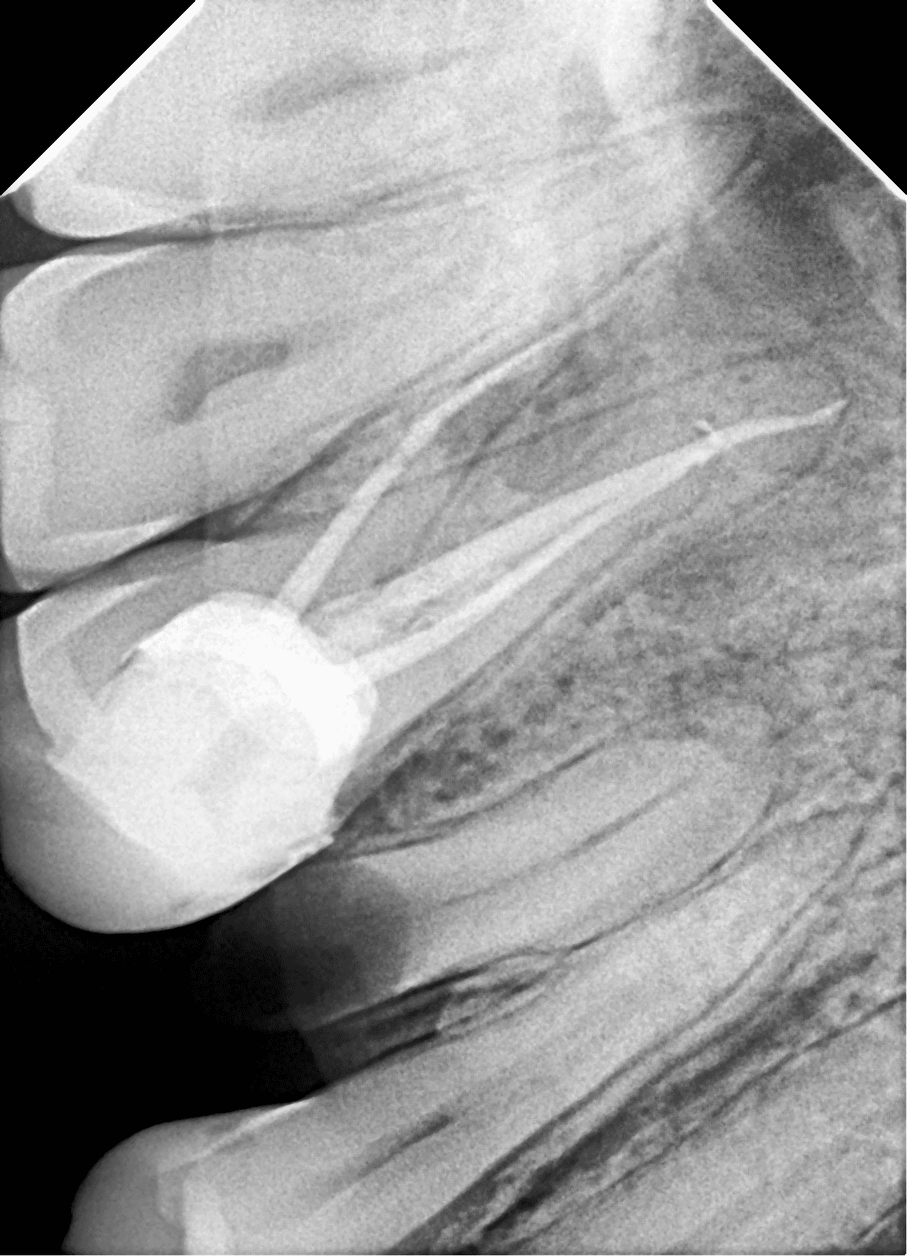 Premium Root-canal Transformation — after treatment