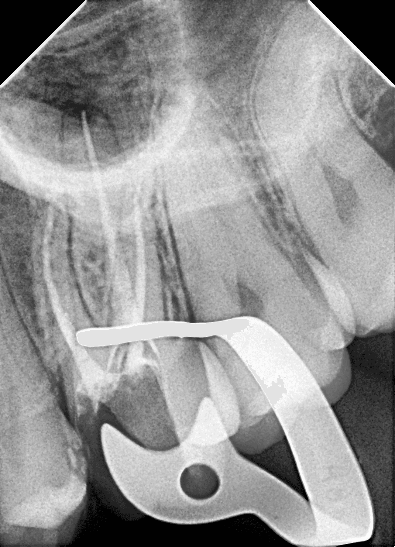 Premium Root-canal Transformation — before treatment