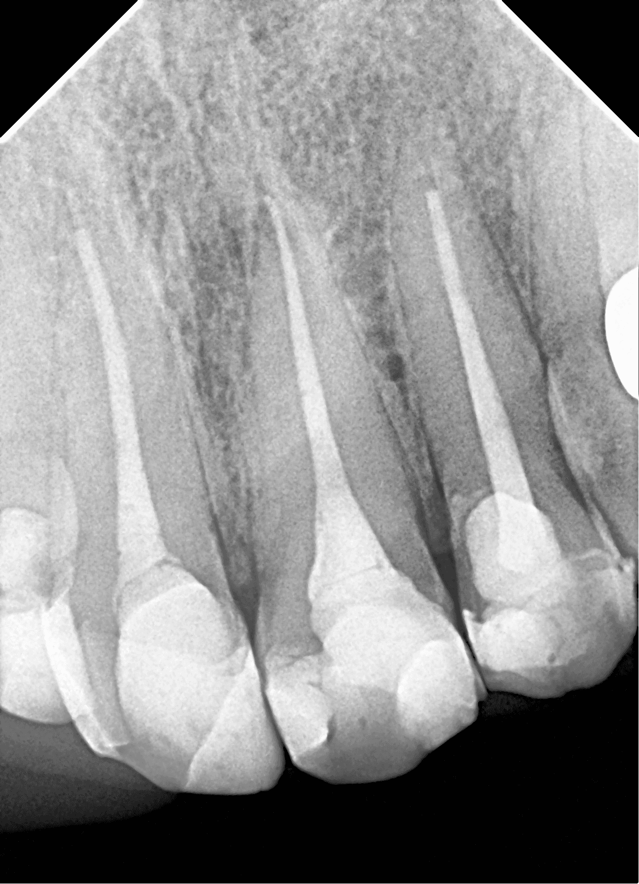 Premium Root-canal Transformation — after treatment