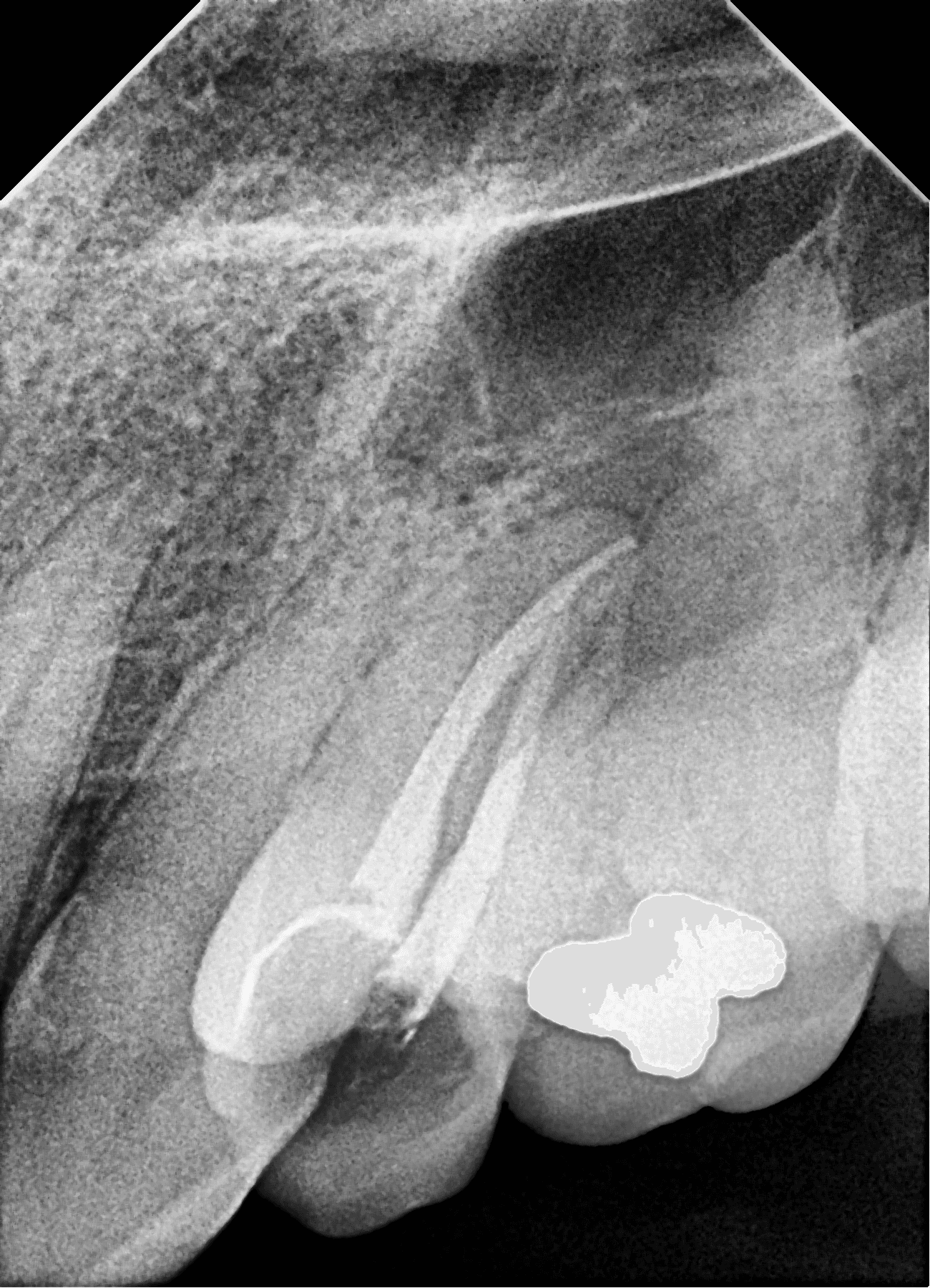 Premium Root-canal Transformation — before treatment