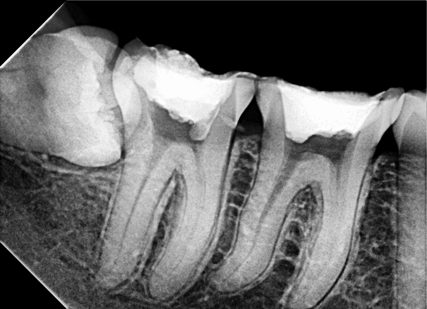 Premium Root-canal Transformation — before treatment