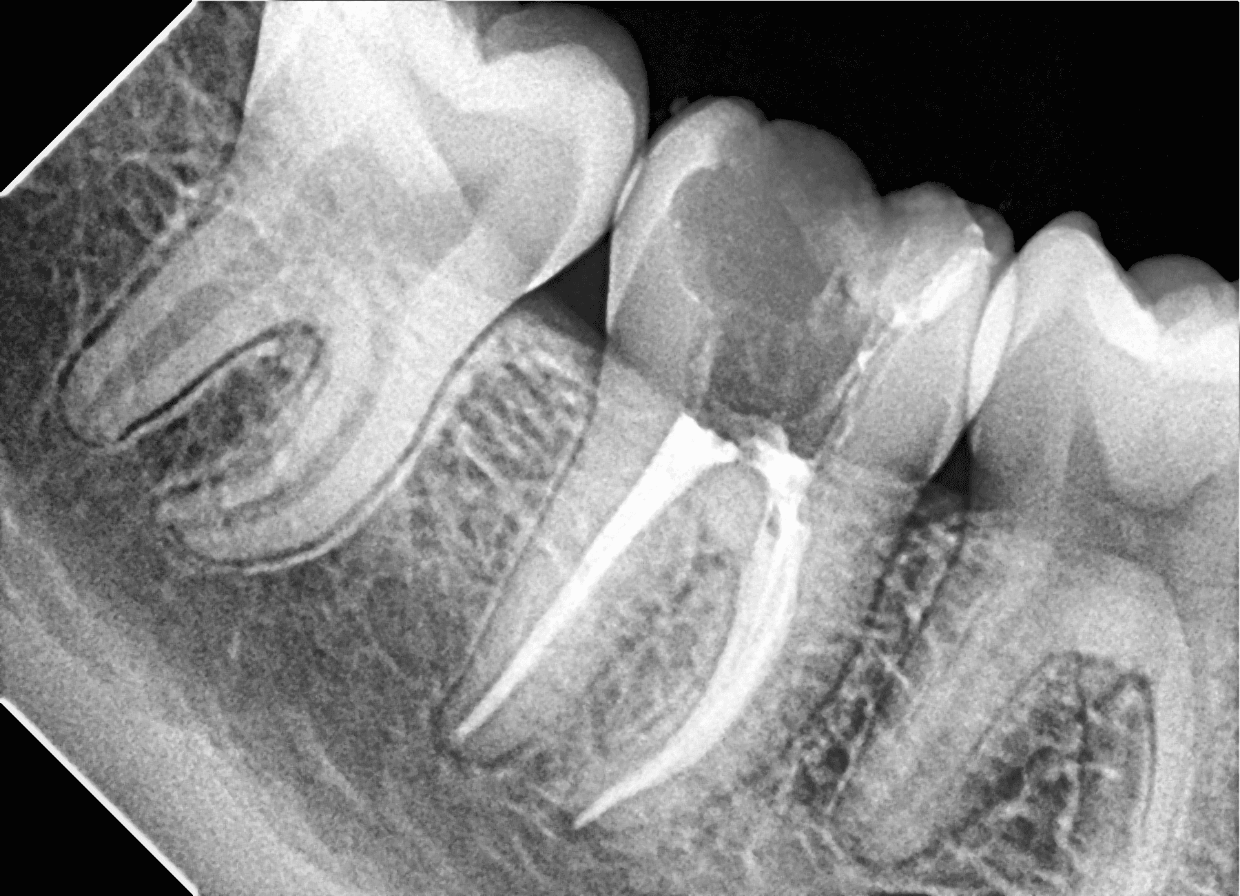 Premium Root-canal Transformation — after treatment