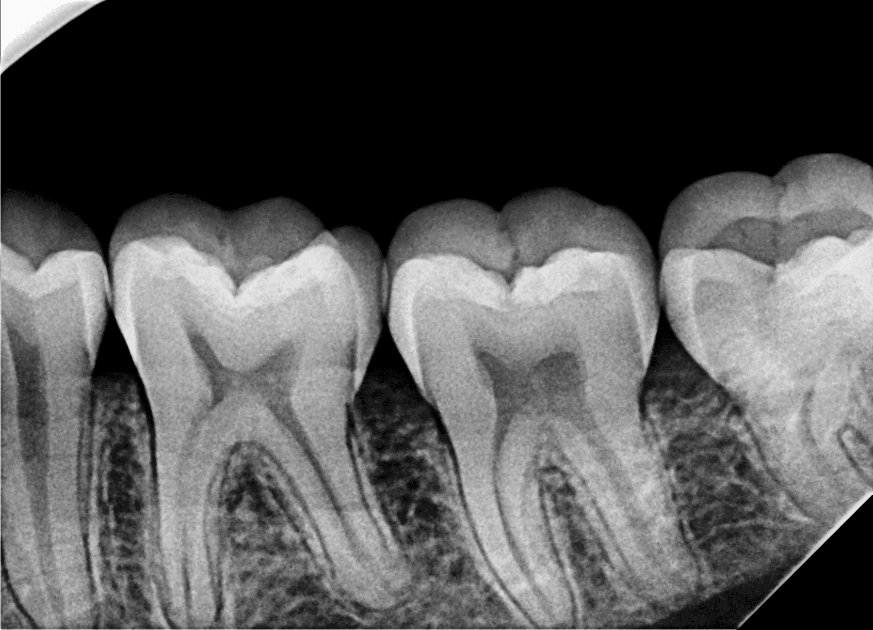 Premium Root-canal Transformation — before treatment