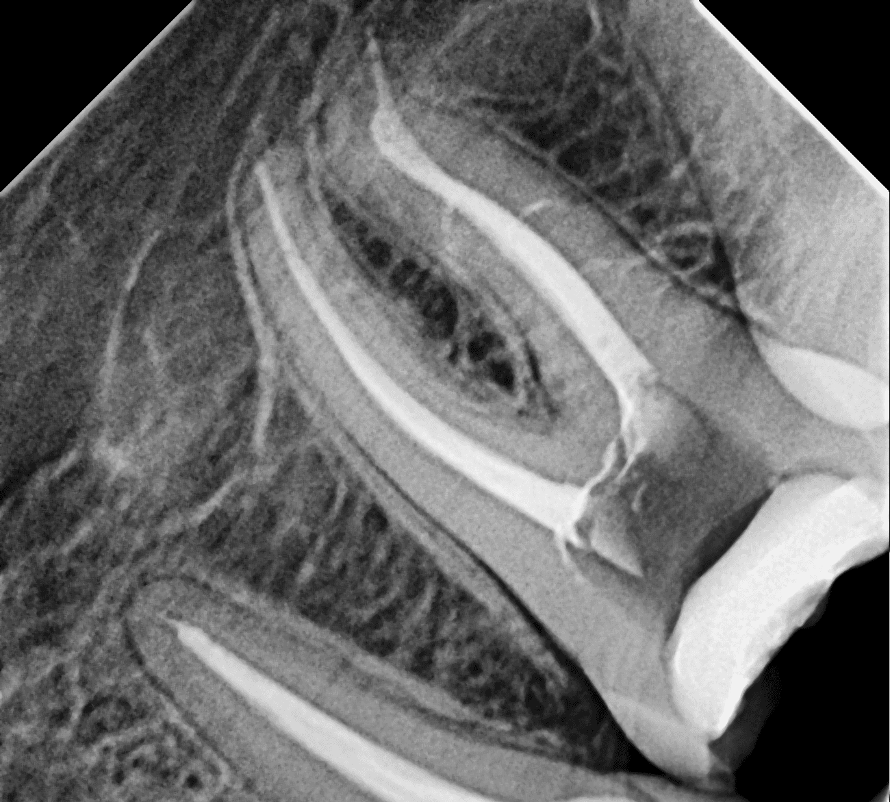 Premium Root-canal Transformation — after treatment