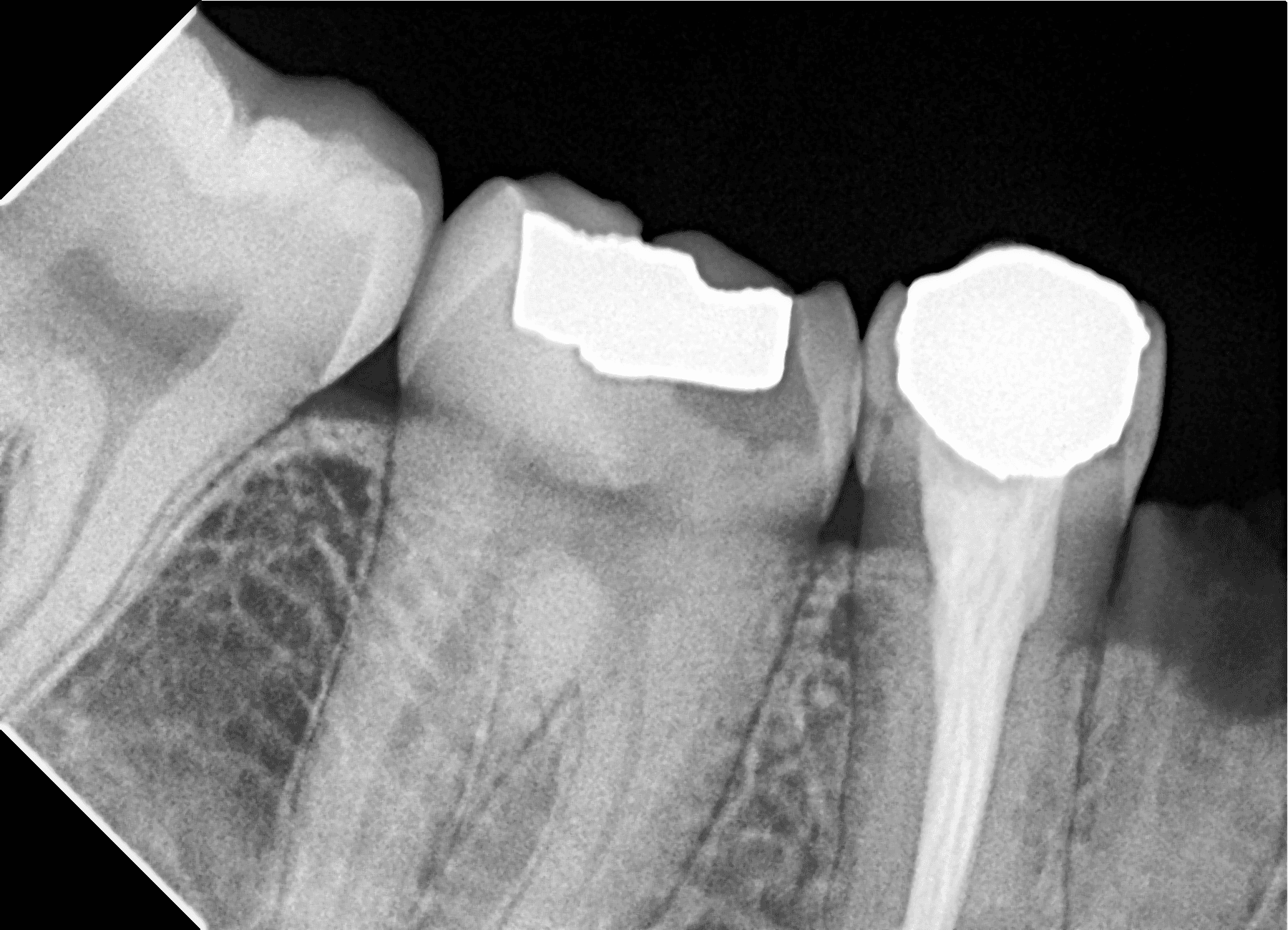 Premium Root-canal Transformation — before treatment