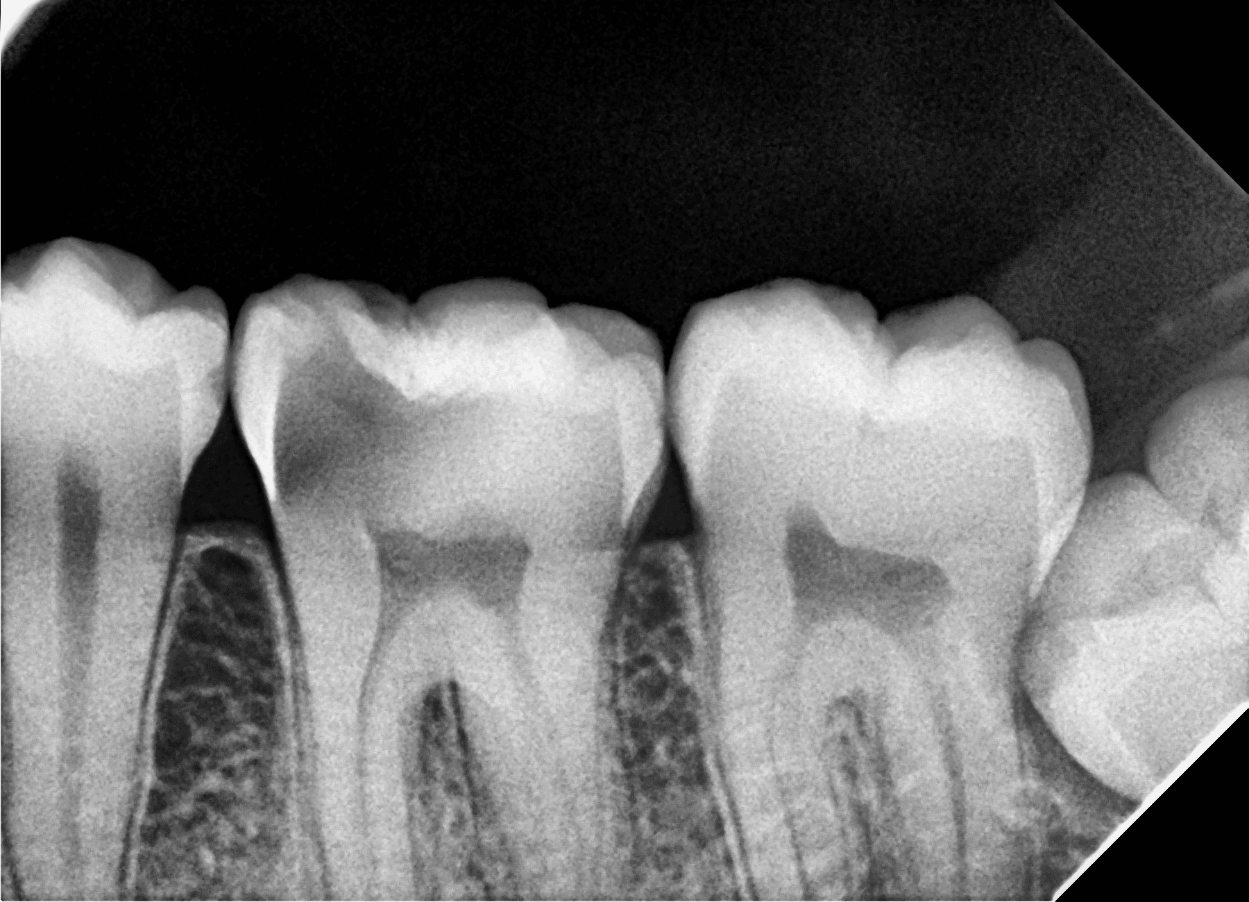 Premium Root-canal Transformation — before treatment