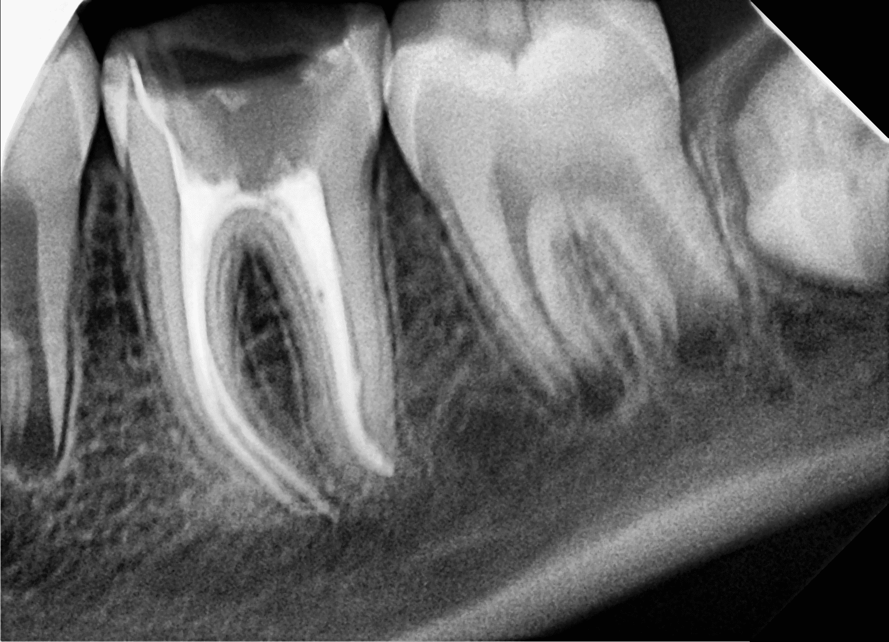 Premium Root-canal Transformation — after treatment