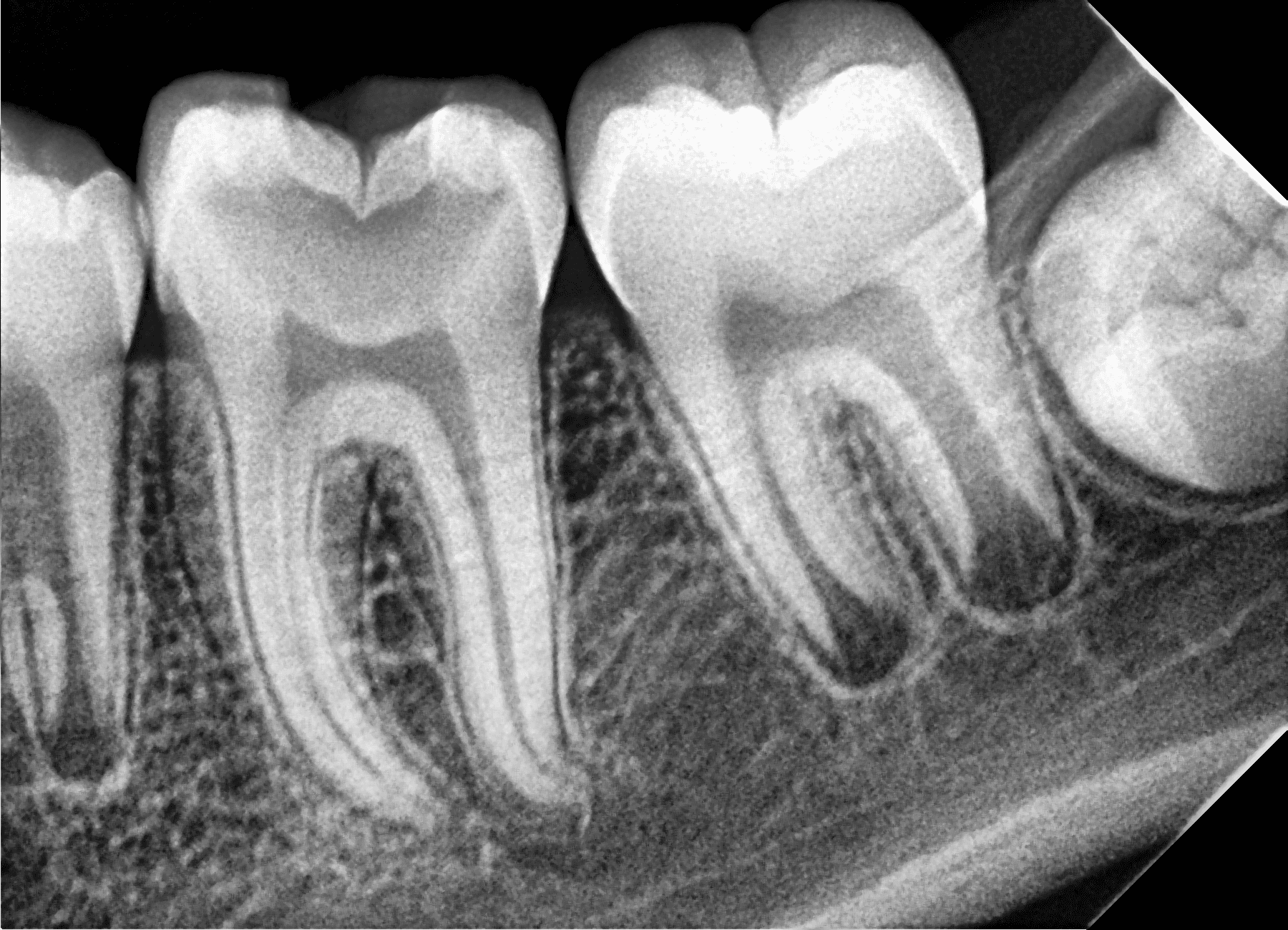 Premium Root-canal Transformation — before treatment