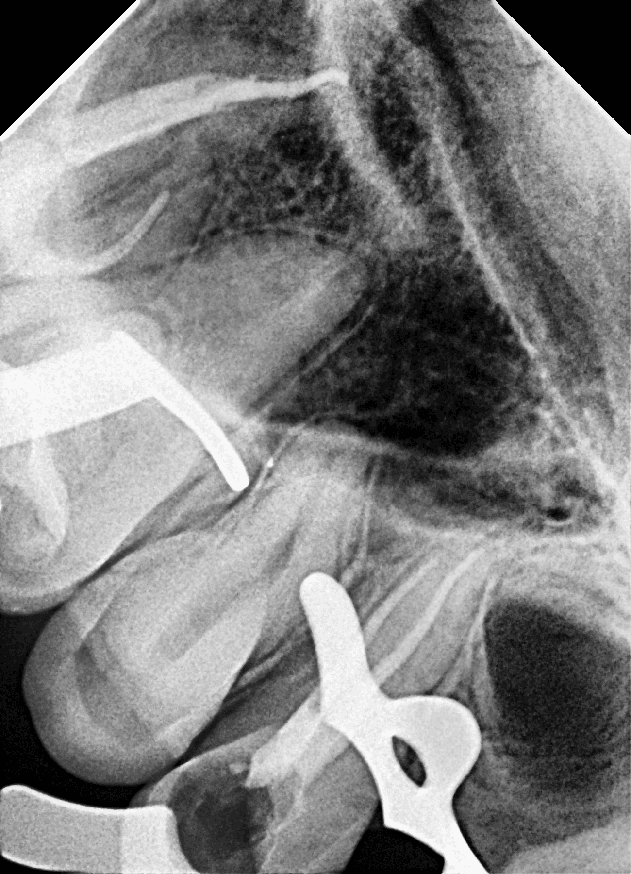 Premium Root-canal Transformation — after treatment