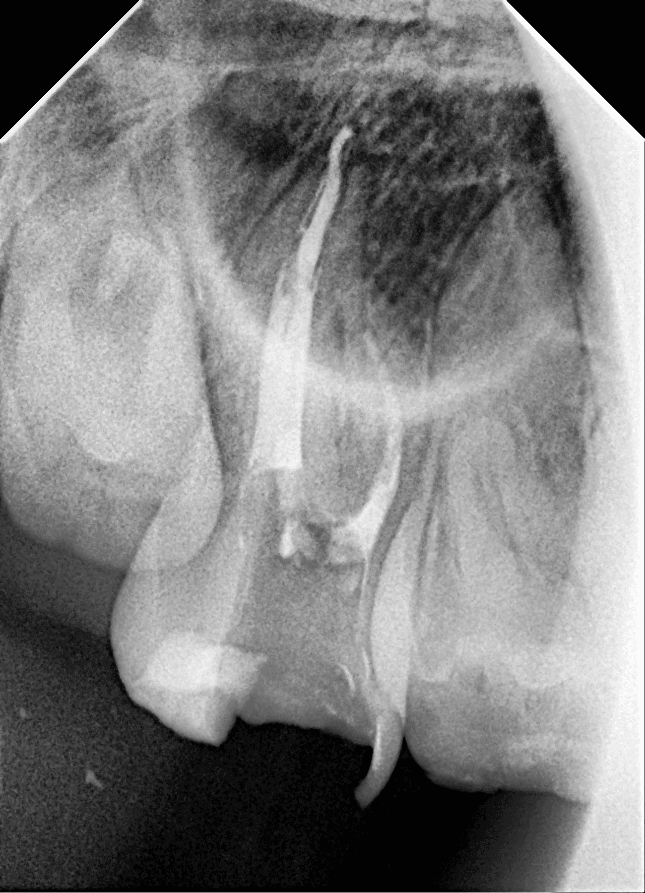 Premium Root-canal Transformation — before treatment