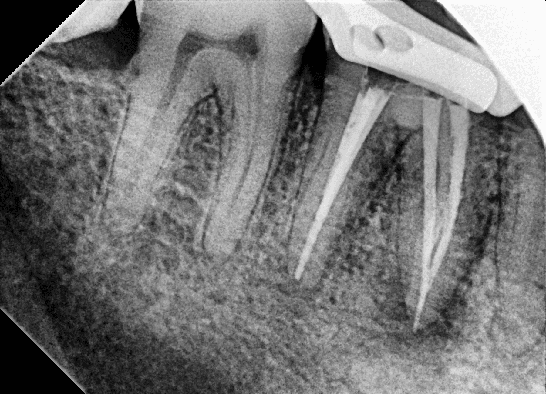 Premium Root-canal Transformation — after treatment