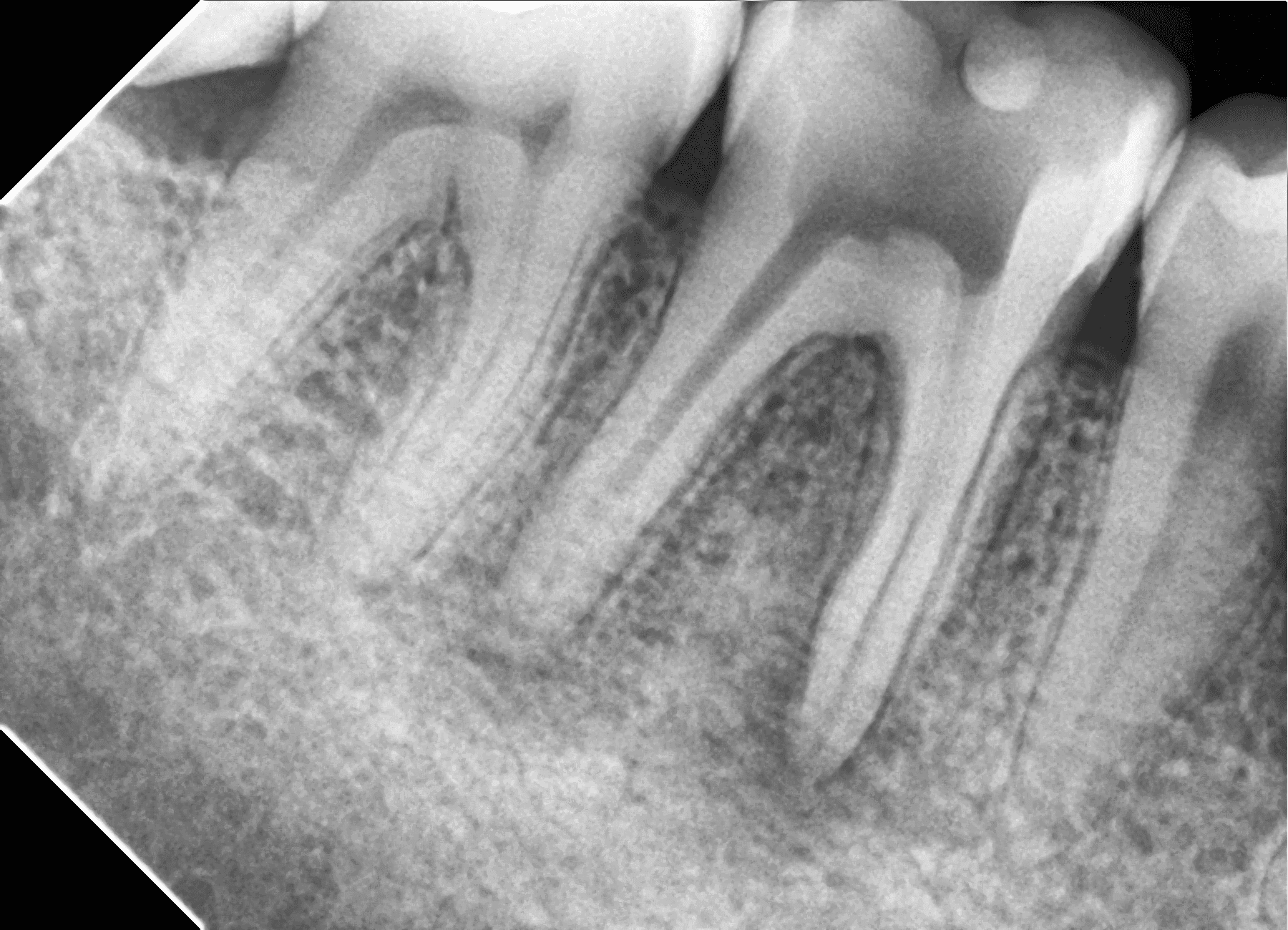Premium Root-canal Transformation — before treatment