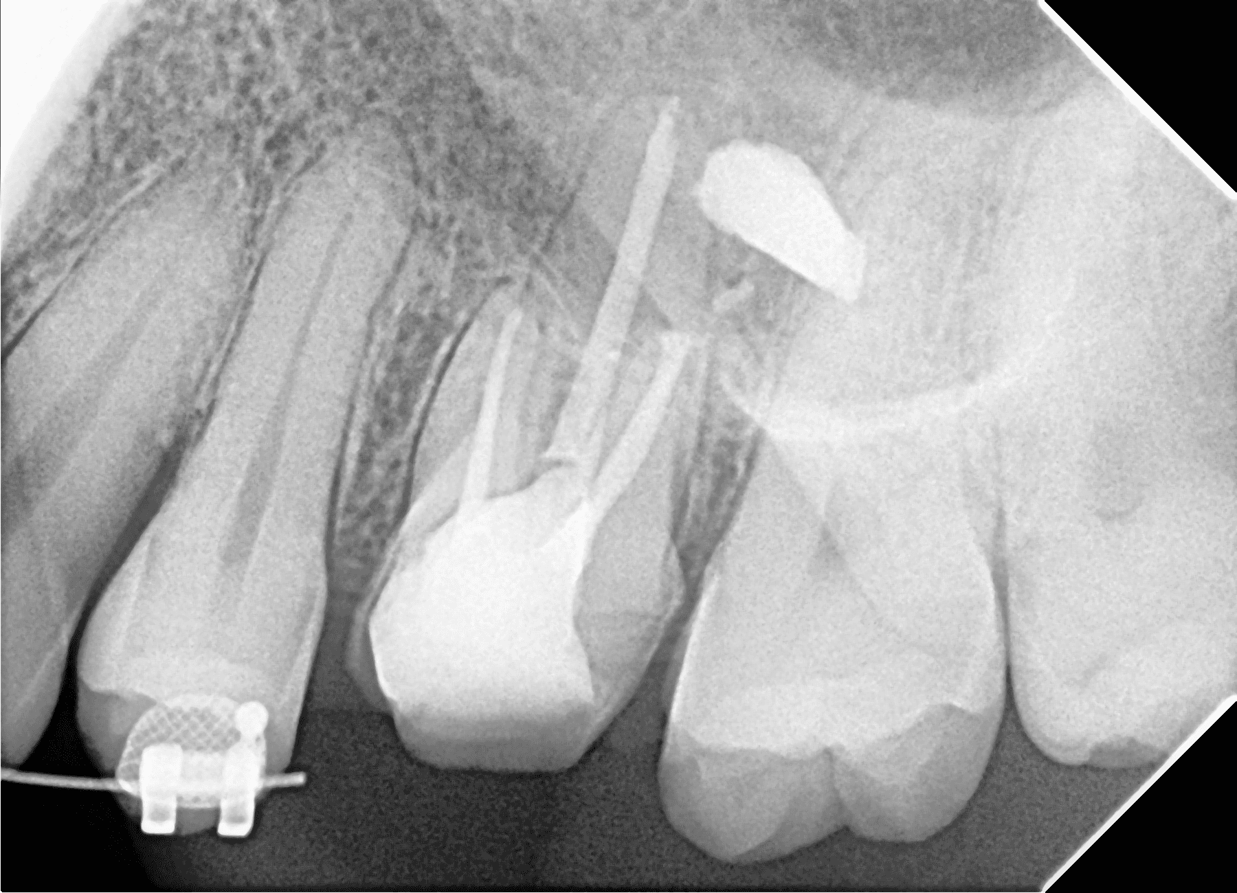 Premium Root-canal Transformation — after treatment