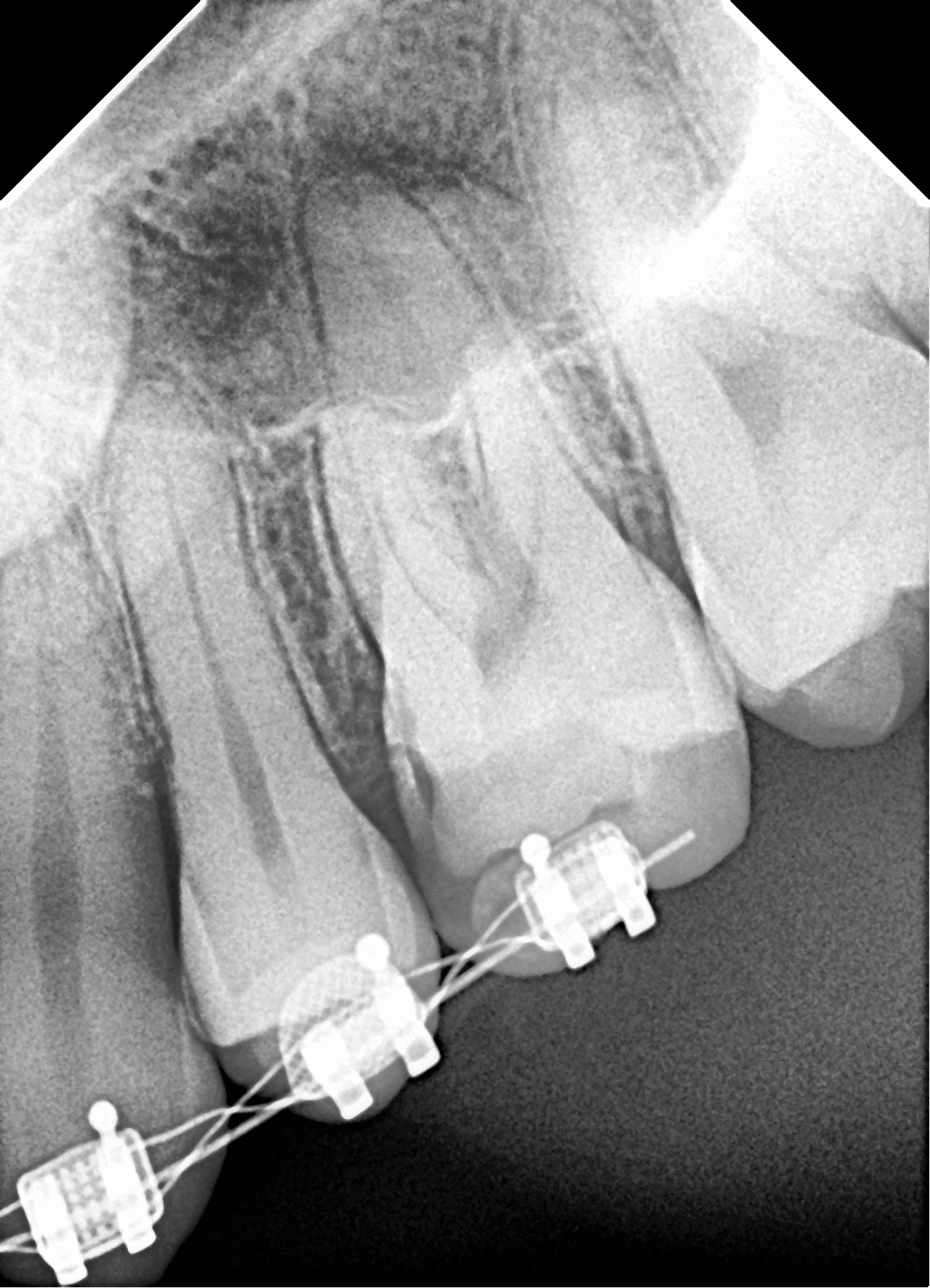 Premium Root-canal Transformation — before treatment