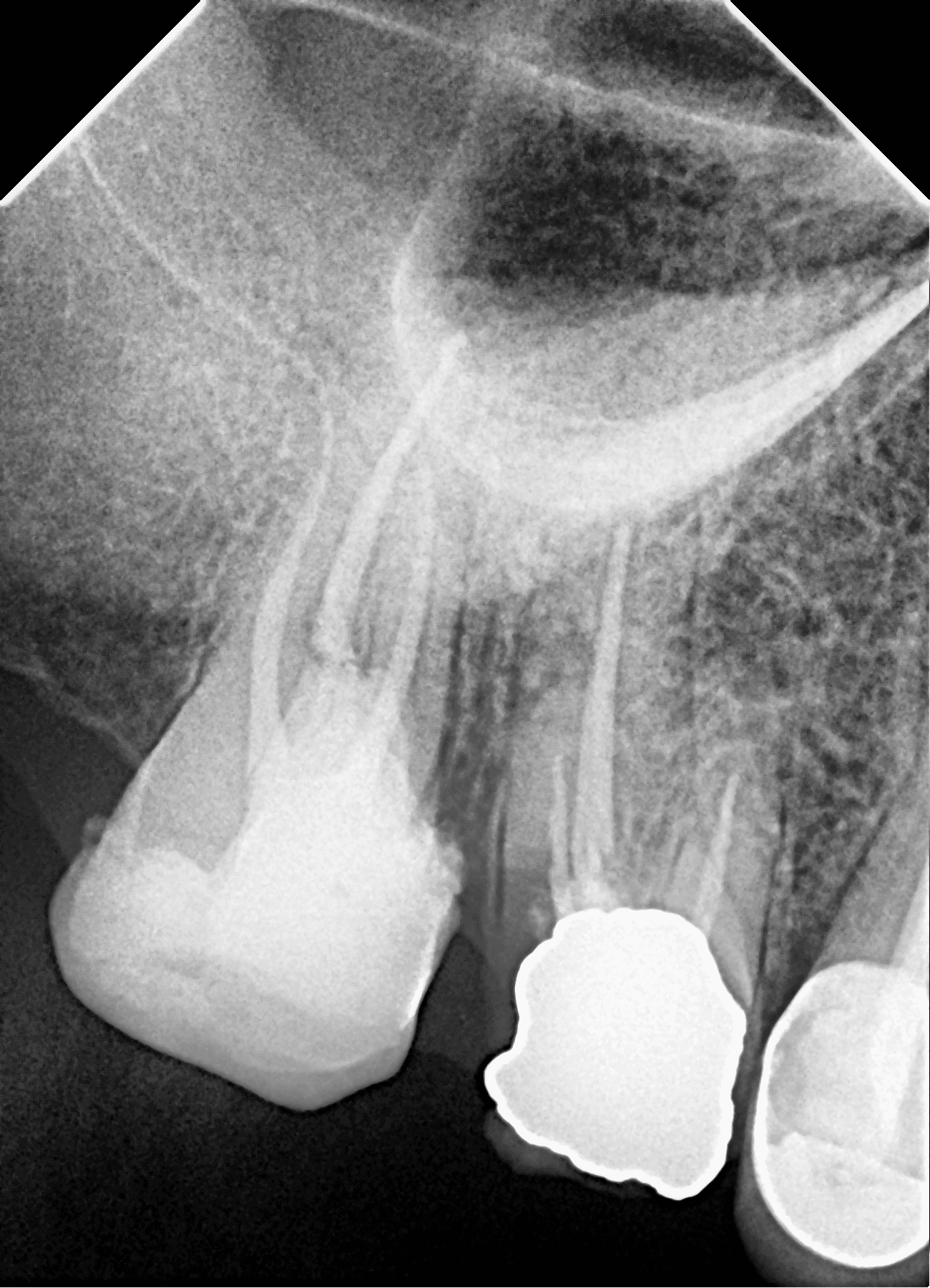 Premium Root-canal Transformation — after treatment
