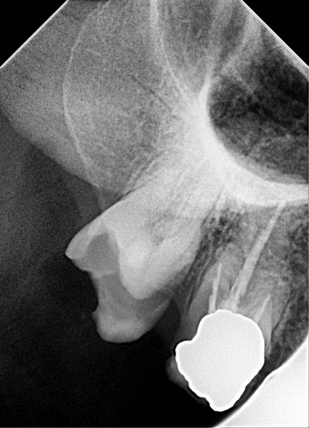 Premium Root-canal Transformation — before treatment