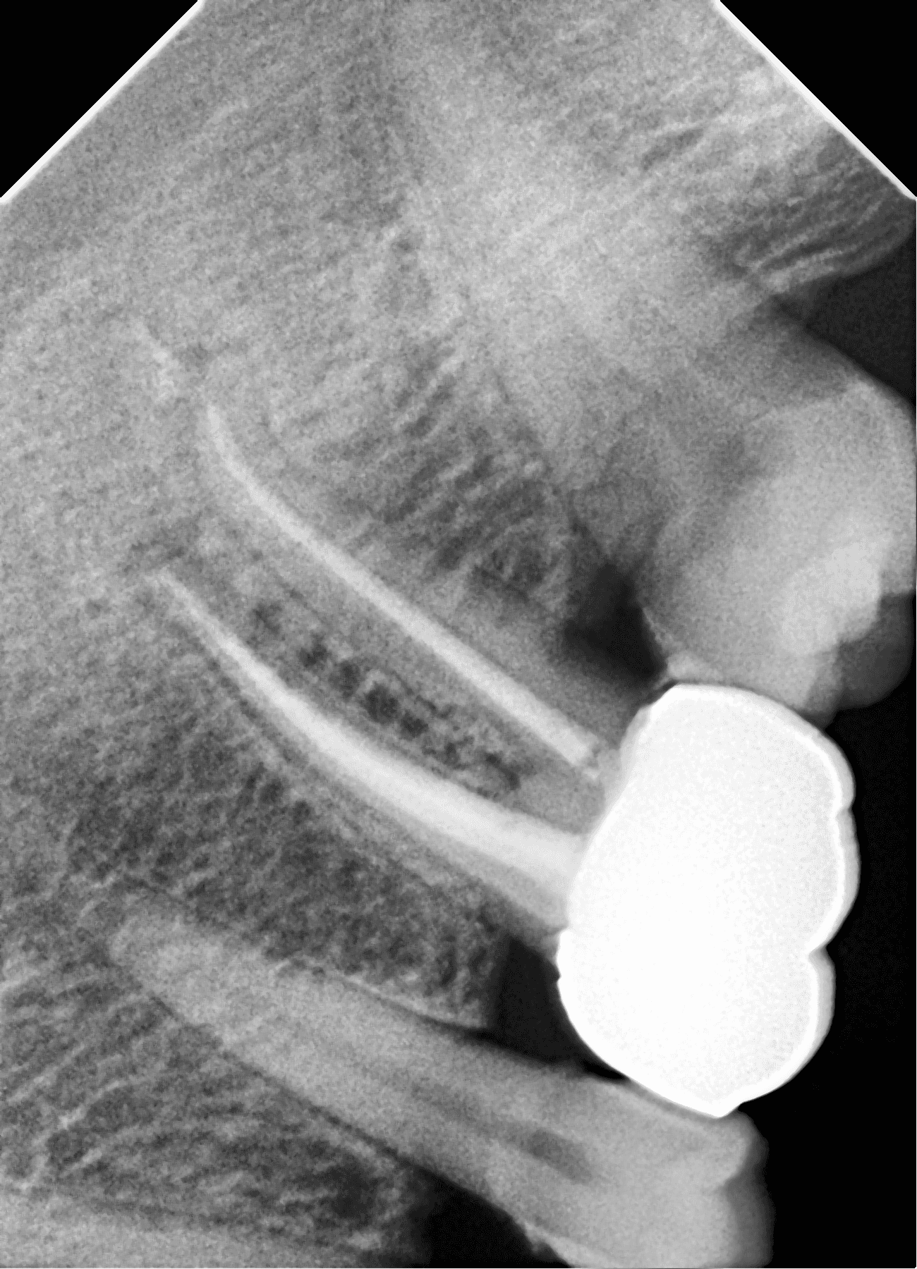 Premium Root-canal Transformation — after treatment