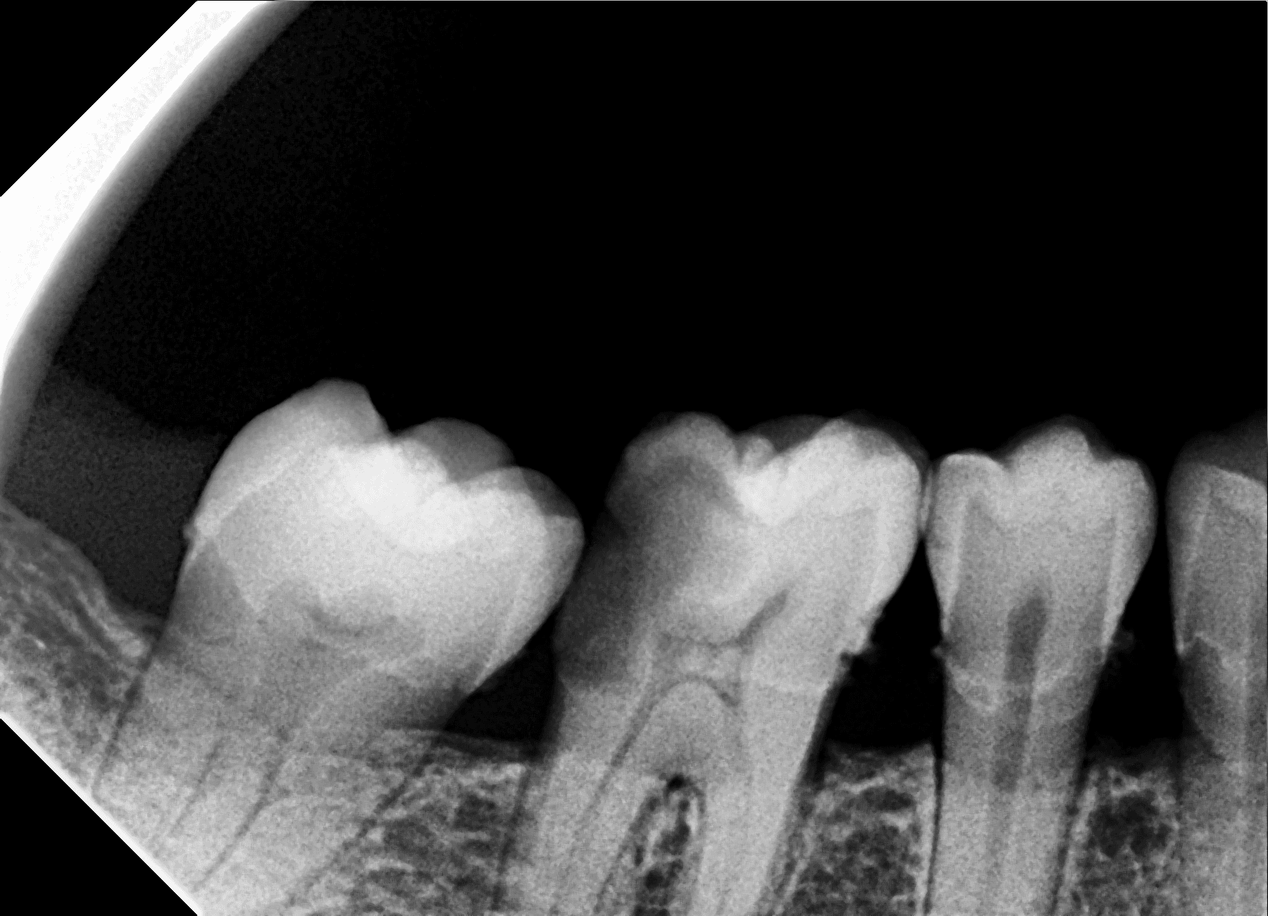 Premium Root-canal Transformation — before treatment
